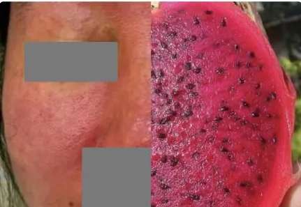 A Hangzhou woman raised a hamster whose face rotten into dragon fruit and a rash appeared all over her body, confirming scrub typhus