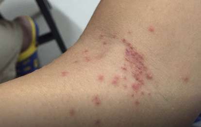 Different insect bites identification pictures
